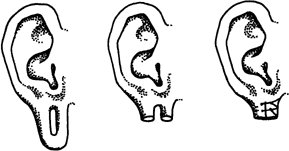 Earlobe Reconstruction History-1.gif