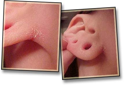 Earpit Irritation-1.jpg