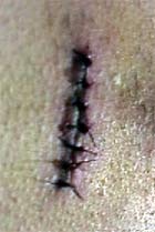 Suture.jpg