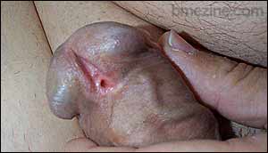 Hypospadia-1.jpg