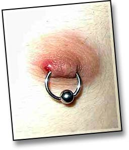 Hypertrophic Scarring-1.jpg