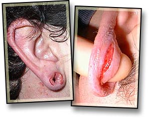 Earlobe Tearing-1.jpg