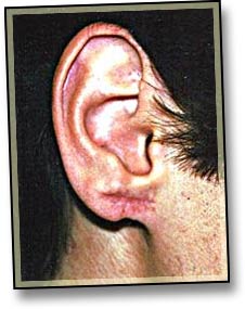 Earlobe Reconstruction-1.jpg