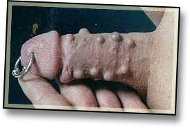 Implant Subdermal Shifting-1.jpg