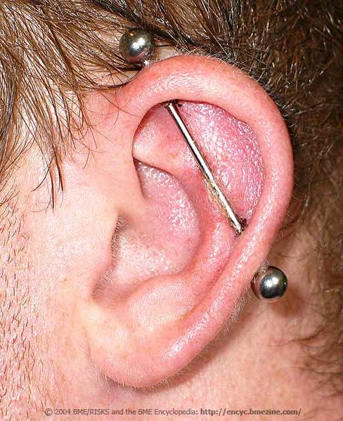 File:Cartilage Swelling-1.jpg